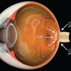 Glaucoma, IOP (6) Glaucoma, IOP (6)