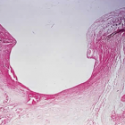 Прогиб (экскавация) зрительного нерва при глаукоме. Источник: oculist Прогиб (экскавация) зрительного нерва при глаукоме. Источник: oculist