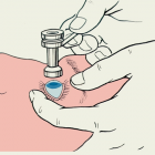 Измерение внутриглазного давления по Маклакову. Источник: dic.academic Измерение внутриглазного давления по Маклакову. Источник: dic.academic