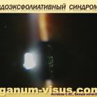 Профессор Астахов С.Ю. Тёмные стороны интраокулярной коррекции. Доклад на XX Международном офтальмологическом конгрессе Белые ночи-2014. Информационный партнер портал Орган зрения organum-visus.com (Рис. 53). Профессор Астахов С.Ю. Тёмные стороны интраокулярной коррекции. Доклад на XX Международном офтальмологическом конгрессе Белые ночи-2014. Информационный партнер портал Орган зрения organum-visus.com (Рис. 53).