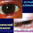 Infection in Eye! Ophthalmology for Therapists. Dry Eye. Video 1. Инфекция в глазу. Интернет-сессия "Офтальмология для терапевтов", г. Москва, Россия, 22 октября 2014г. Совместный проект портала Орган зрения www.organum-visus.com и Всероссийской образовательной программы для врачей "Интернет Сессия" www.internist.ru При поддержке компании Dr.Reddy's Рис. 07. Infection in Eye! Ophthalmology for Therapists. Dry Eye. Video 1. Инфекция в глазу. Интернет-сессия "Офтальмология для терапевтов", г. Москва, Россия, 22 октября 2014г. Совместный проект портала Орган зрения www.organum-visus.com и Всероссийской образовательной программы для врачей "Интернет Сессия" www.internist.ru При поддержке компании Dr.Reddy's Рис. 07.