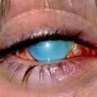 Химический ожог глаза.