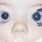 Children glaucoma. Новости офтальмологии портала Орган зрения organum-visus.com Children glaucoma. Новости офтальмологии портала Орган зрения organum-visus.com