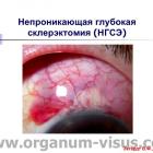 Экгардт В.Ф. НГСЭ и Ex-PRESS® мини шунт в сравнительном аспекте. Доклад на Краевой конференция офтальмологов "Прикамские зори: актуальные вопросы глаукомы", 27 марта 2015г., г. Пермь, Россия. Информационный партнер www.organum-visus.com (Glaucoma) (Рис. 8) Экгардт В.Ф. НГСЭ и Ex-PRESS® мини шунт в сравнительном аспекте. Доклад на Краевой конференция офтальмологов "Прикамские зори: актуальные вопросы глаукомы", 27 марта 2015г., г. Пермь, Россия. Информационный партнер www.organum-visus.com (Glaucoma) (Рис. 8)