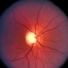 Диск зрительного нерва при глаукоме. Диск зрительного нерва при глаукоме.