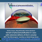 Dmitry Ivanov, Oleg Shilovskih, Dmitry Bardasov (IRTC "Eye Microsurgery", Ekaterinburg, Russia). Variant of phacoemulsification in cases with extensive defects of Zinn's zonulae. Новости офтальмологии портала Орган зрения www.organum-visus.com, 2 Dmitry Ivanov, Oleg Shilovskih, Dmitry Bardasov (IRTC "Eye Microsurgery", Ekaterinburg, Russia). Variant of phacoemulsification in cases with extensive defects of Zinn's zonulae. Новости офтальмологии портала Орган зрения www.organum-visus.com, 2
