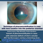 Dmitry Ivanov, Oleg Shilovskih, Dmitry Bardasov (IRTC "Eye Microsurgery", Ekaterinburg, Russia). Variant of phacoemulsification in cases with extensive defects of Zinn's zonulae. Новости офтальмологии портала Орган зрения www.organum-visus.com, 3 Dmitry Ivanov, Oleg Shilovskih, Dmitry Bardasov (IRTC "Eye Microsurgery", Ekaterinburg, Russia). Variant of phacoemulsification in cases with extensive defects of Zinn's zonulae. Новости офтальмологии портала Орган зрения www.organum-visus.com, 3