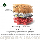 News Retinal Disease. Результаты долгосрочного наблюдения пациентов с ВМД (AMD) на фоне приема лютеинсодержащего препарата. Новости офтальмологии портала Орган зрения organum-visus.com News Retinal Disease. Результаты долгосрочного наблюдения пациентов с ВМД (AMD) на фоне приема лютеинсодержащего препарата. Новости офтальмологии портала Орган зрения organum-visus.ru