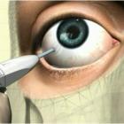 Интравитреальная инъекция препарата Озурдекс (Аллерган). Shot in the eye, Ozurdex. Shot in the eye, Ozurdex.