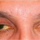 Prostaglandi-associated Periorbitopathy (PAP, простагландин-ассоциированная периорбитопатия). Новости офтальмологии портала Орган зрения (news) www.organum-visus.com Prostaglandi-associated Periorbitopathy (PAP, простагландин-ассоциированная периорбитопатия). Новости офтальмологии портала Орган зрения (news) www.organum-visus.com