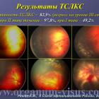 Ревта А.М. 20-летний опыт активного скрининга ретинопатии недоношенных. Доклад на X Съезде офтальмологов России, Москва, 2015. Энциклопедия офтальмологии портала Орган зрения www.organum-visus.com (Рис. 30)