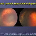 Ревта А.М. 20-летний опыт активного скрининга ретинопатии недоношенных. Доклад на X Съезде офтальмологов России, Москва, 2015. Энциклопедия офтальмологии портала Орган зрения www.organum-visus.com (Рис. 31)