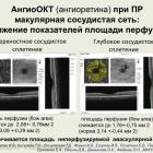 Зольникова И.В., Киселева Т.Н., Охоцимская Т.Д., Фомин А.В., Егорова И.В., Рогатина Е.В., Рамазанова К.А., Еремеева Е.А., Левина Д.В., Деменкова О.Н., Фадеева В.А. Комплексная диагностика пигментного ретинита современнымиклинико-инструментальными методами. Доклад на МАКУЛА-2016. Портал Орган зрения organum-visus.ru (Рис. 17)