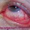 Infection in Eye! Ophthalmology for Therapists. Dry Eye. Video 1. Инфекция в глазу. Интернет-сессия "Офтальмология для терапевтов", г. Москва, Россия, 22 октября 2014г. Совместный проект портала Орган зрения www.organum-visus.com и Всероссийской образовательной программы для врачей "Интернет Сессия" www.internist.ru При поддержке компании Dr.Reddy's Рис. 62.