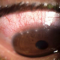 Chlamydial keratoconjunctivitis.