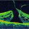 Macular hole. Источник: retinadoctor.com Macular hole.