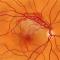 Окклюзия вен сетчатки, Retinal vein occlusion (CRVO).